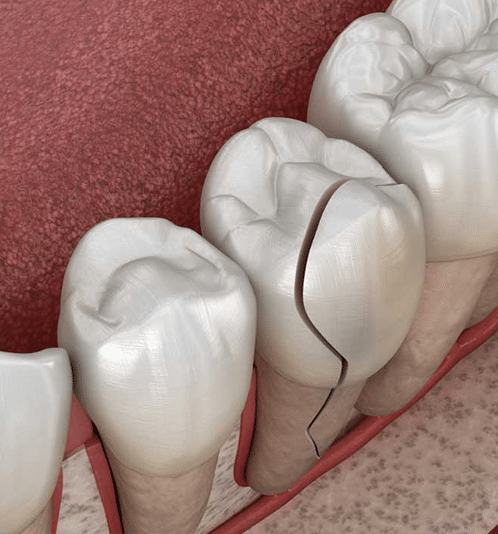 Dental model showing three white tooth crowns on pink base for prosthodontic demonstration.