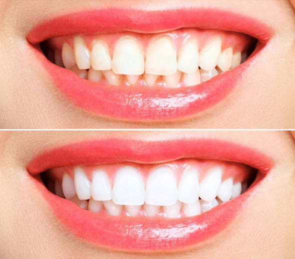 Before and after teeth whitening comparison showing brightened smile results.