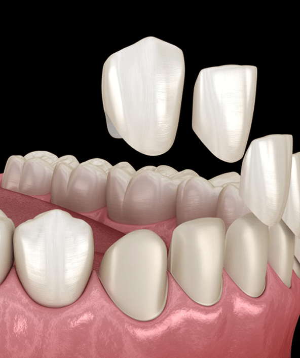 Dental crowns and veneers displayed on pink gum model showing tooth restoration options.