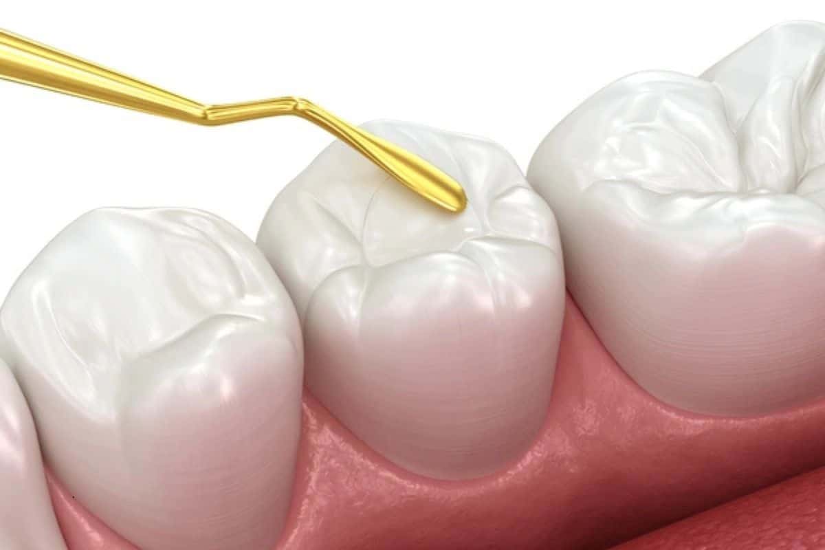 Why White Fillings Are the Modern Choice for Cavities
