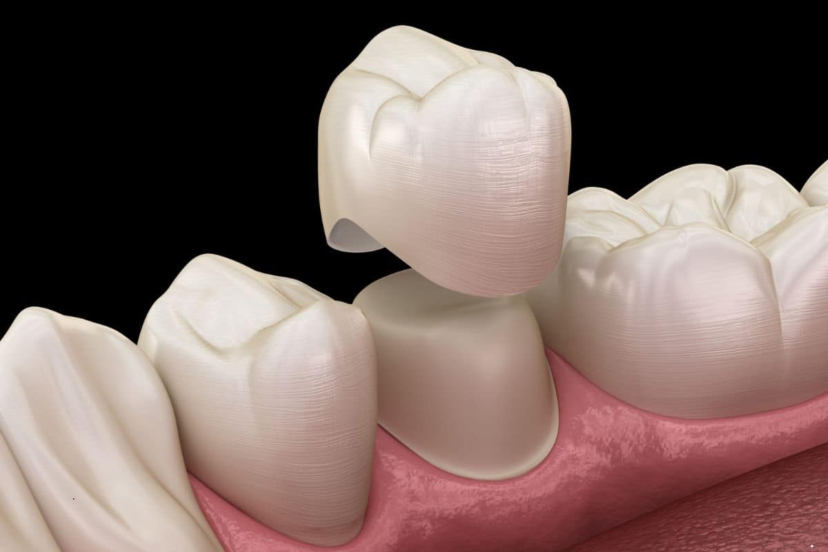 Same-Day vs. Traditional Crowns